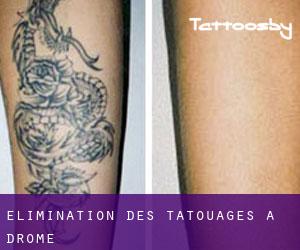Élimination des tatouages à Drôme