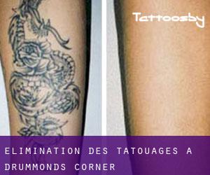 Élimination des tatouages à Drummonds Corner