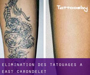 Élimination des tatouages à East Carondelet