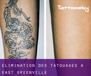 Élimination des tatouages à East Greenville