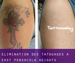 Élimination des tatouages à East Pensacola Heights