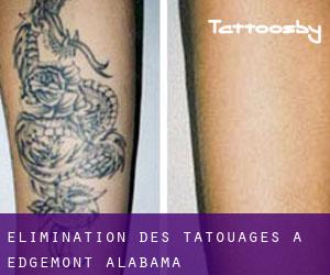 Élimination des tatouages à Edgemont (Alabama)