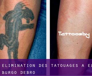 Élimination des tatouages à El Burgo d'Ebro