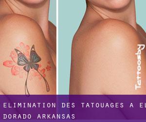 Élimination des tatouages à El Dorado (Arkansas)
