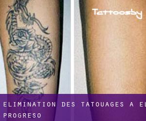 Élimination des tatouages à El Progreso