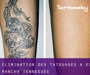 Élimination des tatouages à El Rancho (Tennessee)