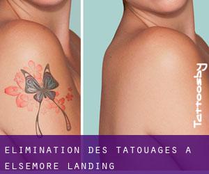 Élimination des tatouages à Elsemore Landing