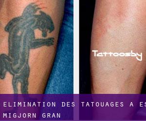 Élimination des tatouages à es Migjorn Gran