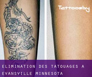 Élimination des tatouages à Evansville (Minnesota)