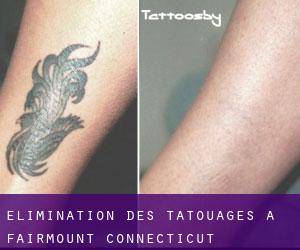 Élimination des tatouages à Fairmount (Connecticut)