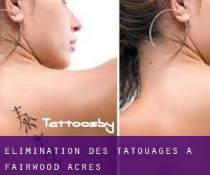 Élimination des tatouages à Fairwood Acres
