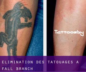 Élimination des tatouages à Fall Branch