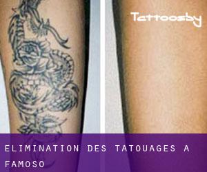 Élimination des tatouages à Famoso
