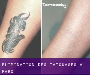 Élimination des tatouages à Faro