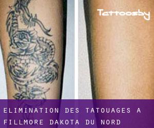 Élimination des tatouages à Fillmore (Dakota du Nord)