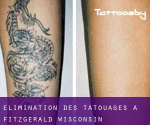 Élimination des tatouages à Fitzgerald (Wisconsin)