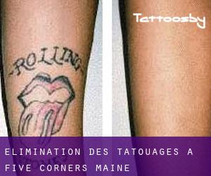 Élimination des tatouages à Five Corners (Maine)