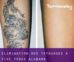 Élimination des tatouages à Five Forks (Alabama)