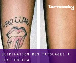 Élimination des tatouages à Flat Hollow