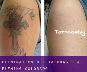 Élimination des tatouages à Fleming (Colorado)