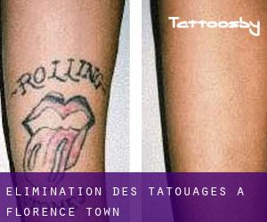 Élimination des tatouages à Florence Town