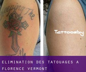 Élimination des tatouages à Florence (Vermont)