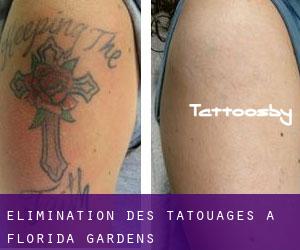 Élimination des tatouages à Florida Gardens