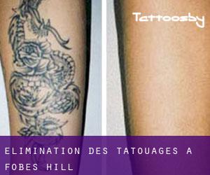 Élimination des tatouages à Fobes Hill