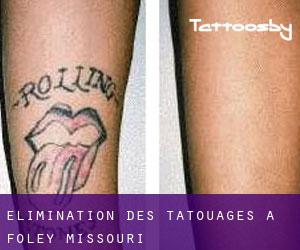 Élimination des tatouages à Foley (Missouri)