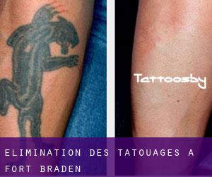 Élimination des tatouages à Fort Braden