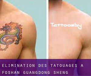 Élimination des tatouages à Foshan (Guangdong Sheng)