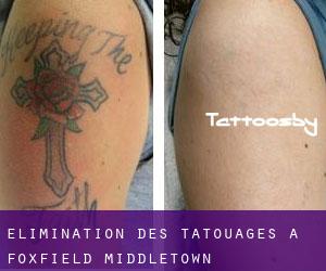 Élimination des tatouages à Foxfield Middletown