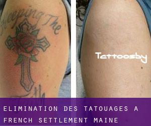 Élimination des tatouages à French Settlement (Maine)