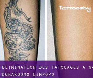 Élimination des tatouages à Ga-Dukakgomo (Limpopo)