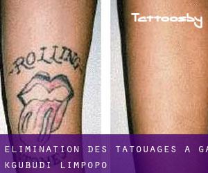 Élimination des tatouages à Ga-Kgubudi (Limpopo)