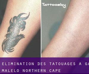 Élimination des tatouages à Ga-Malelo (Northern Cape)