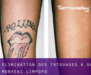 Élimination des tatouages à Ga-Monyeki (Limpopo)
