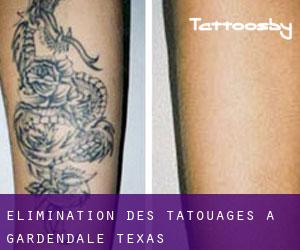 Élimination des tatouages à Gardendale (Texas)