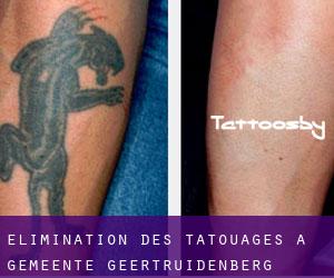 Élimination des tatouages à Gemeente Geertruidenberg