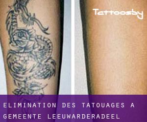 Élimination des tatouages à Gemeente Leeuwarderadeel