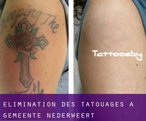 Élimination des tatouages à Gemeente Nederweert
