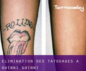 Élimination des tatouages à Ghinni Ghinni