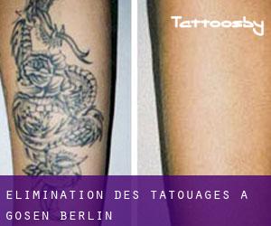 Élimination des tatouages à Gosen (Berlin)