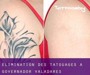 Élimination des tatouages à Governador Valadares