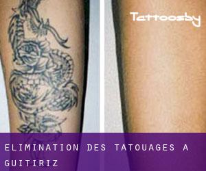 Élimination des tatouages à Guitiriz