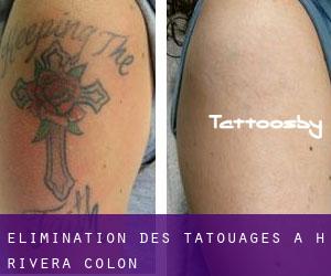 Élimination des tatouages à H. Rivera Colon