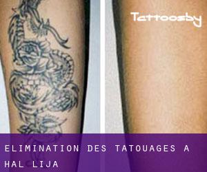 Élimination des tatouages à Ħal Lija