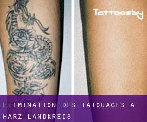 Élimination des tatouages à Harz Landkreis