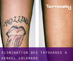 Élimination des tatouages à Henkel (Colorado)