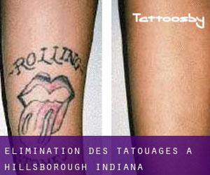 Élimination des tatouages à Hillsborough (Indiana)